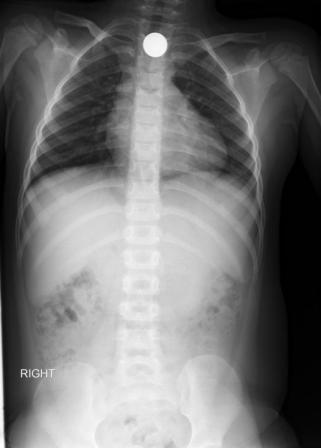 X-ray image of a child who visited ImageCare after swallowing a penny.
