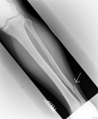 This patient came in after a fall down the stairs. The patient had an x-ray of their tibia-fibula and a fracture was discovered.